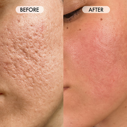 ScarlessMD™ Deep PDRN+ Acne Scar Micro-Infusion System